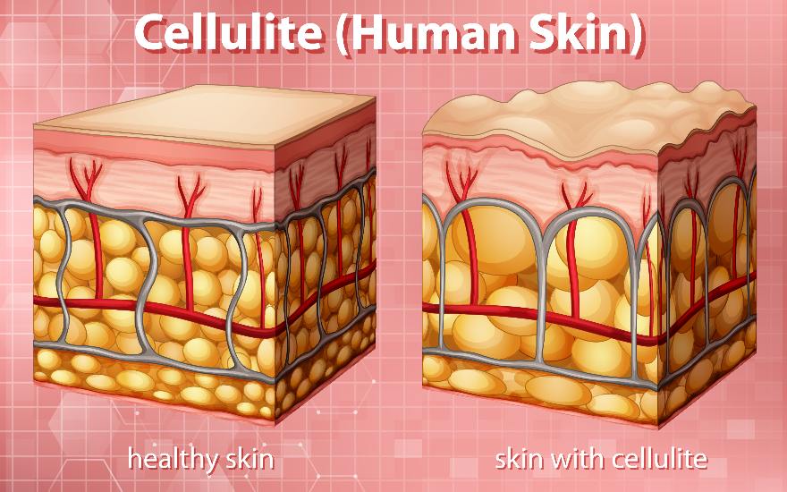 diosmina per pelle con cellulite