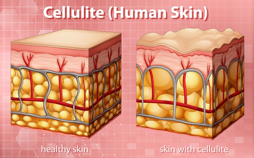 imperfections of cellulite